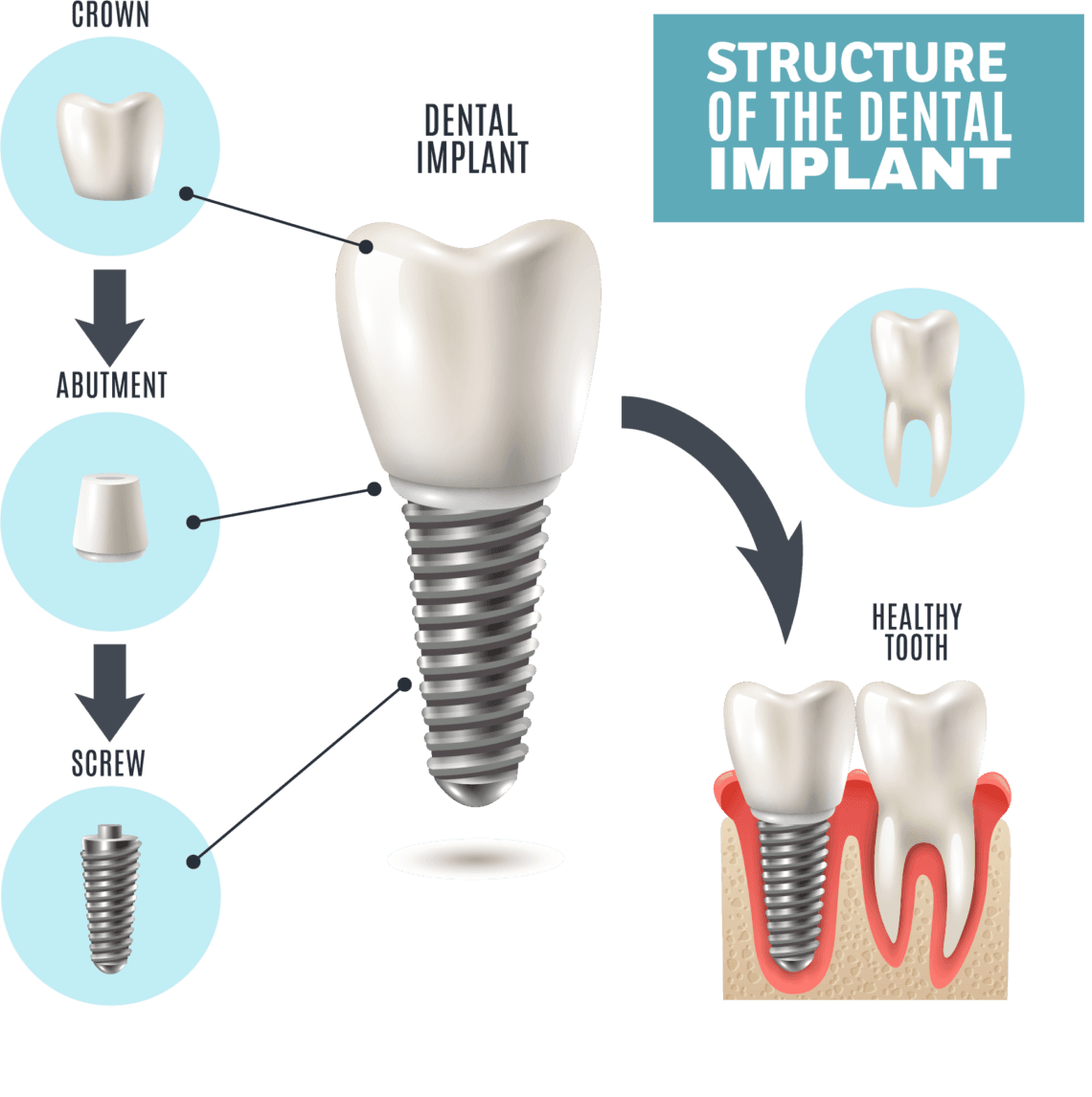 dental implant